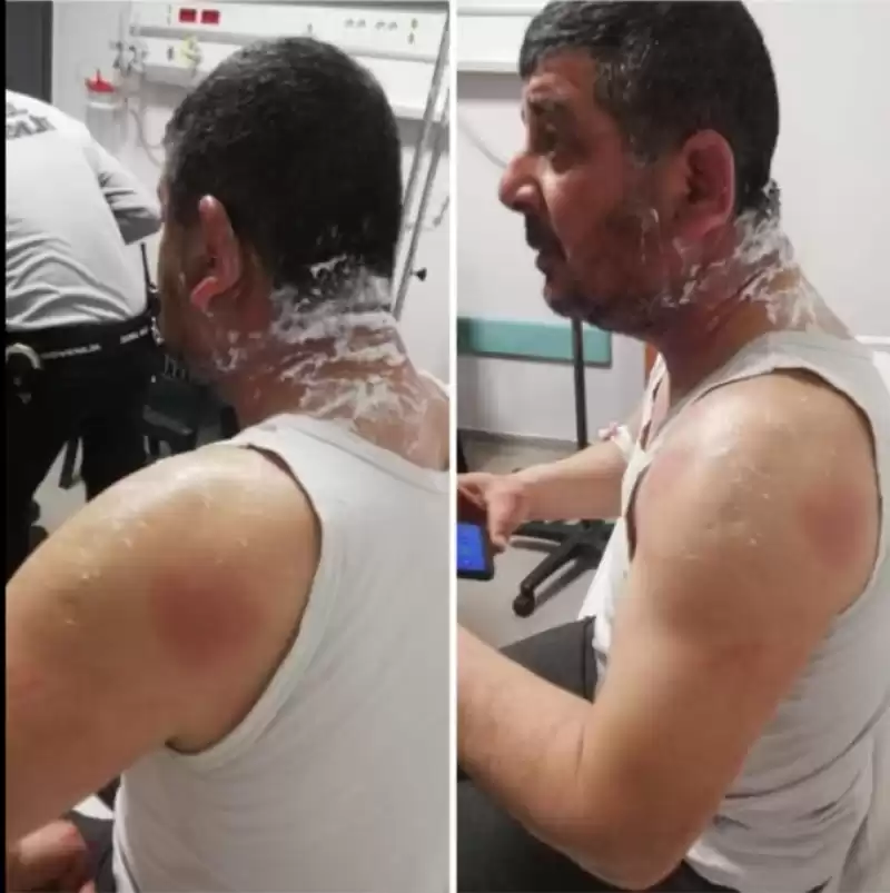“Demokrat Parti Hatay Dörtyol Belediye Meclisi Üyesi Adayı Oğuzhan Lök,  MHP Adayının Eşinin Dayısı Tarafından üzerine Asit Atılarak Saldırıya Uğradı”